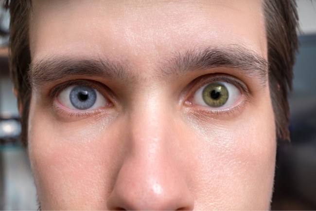 Você está visualizando atualmente Por que algumas pessoas têm olhos de cores diferentes?